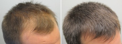 Миноксидил Кирклэнд 5% (Minoxidil Kirkland Signature) 1 месяц
