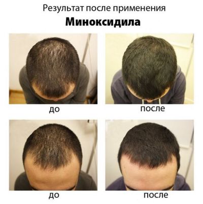 Миноксидил Minoxidil kirkland до и после