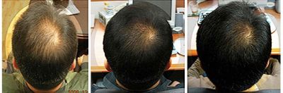 Миноксидил Minoxidil kirkland 3 месяца результаты