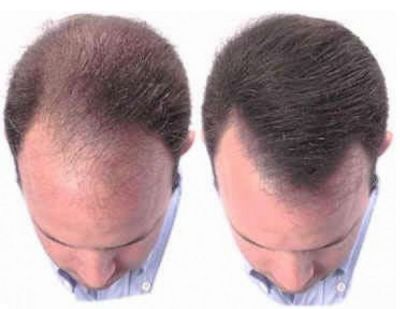 Миноксидил Minoxidil 6 месяцев результат